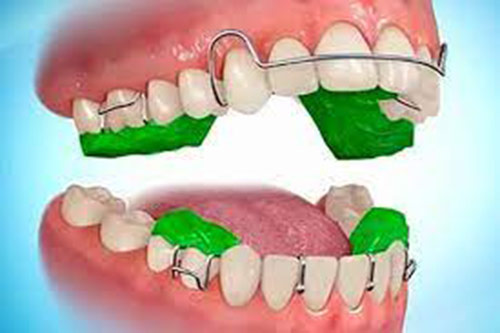 Myofunctional Appliances